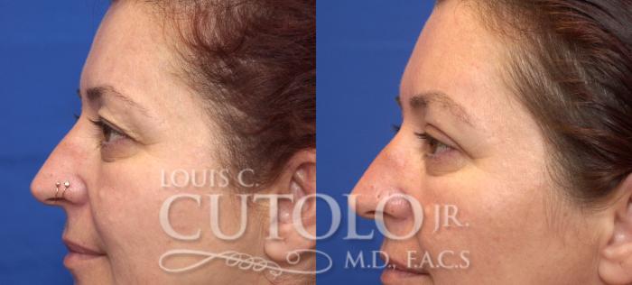 Before & After Eyelid Surgery Case 45 View #3 View in Brooklyn, Staten Island, Queens, NY