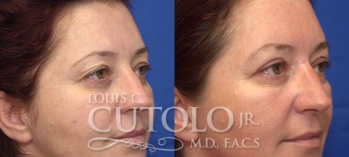 Before & After Eyelid Surgery Case 45 View #4 View in Brooklyn, Staten Island, Queens, NY