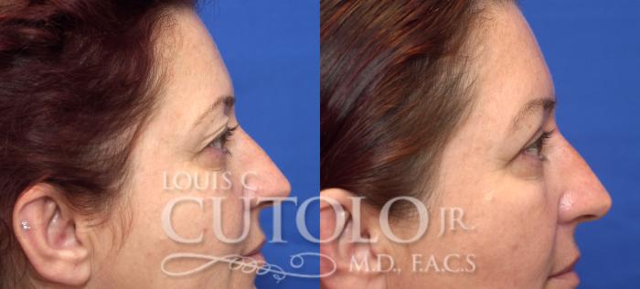 Before & After Eyelid Surgery Case 45 View #5 View in Brooklyn, Staten Island, Queens, NY