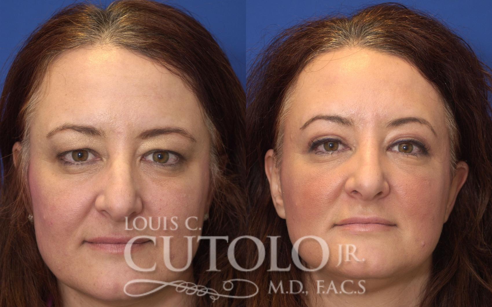 Before & After Eyelid Surgery Case 46 View #1 View in Brooklyn, Staten Island, Queens, NY