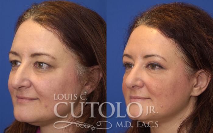 Before & After Eyelid Surgery Case 46 View #2 View in Brooklyn, Staten Island, Queens, NY