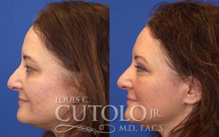 Before & After Eyelid Surgery Case 46 View #3 View in Brooklyn, Staten Island, Queens, NY