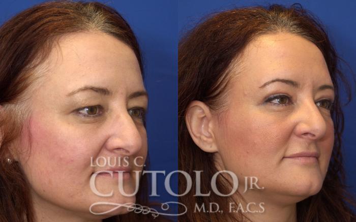 Before & After Eyelid Surgery Case 46 View #4 View in Brooklyn, Staten Island, Queens, NY