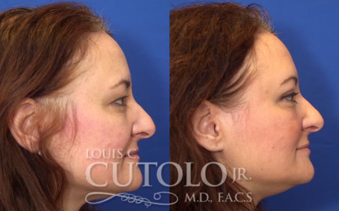 Before & After Eyelid Surgery Case 46 View #5 View in Brooklyn, Staten Island, Queens, NY