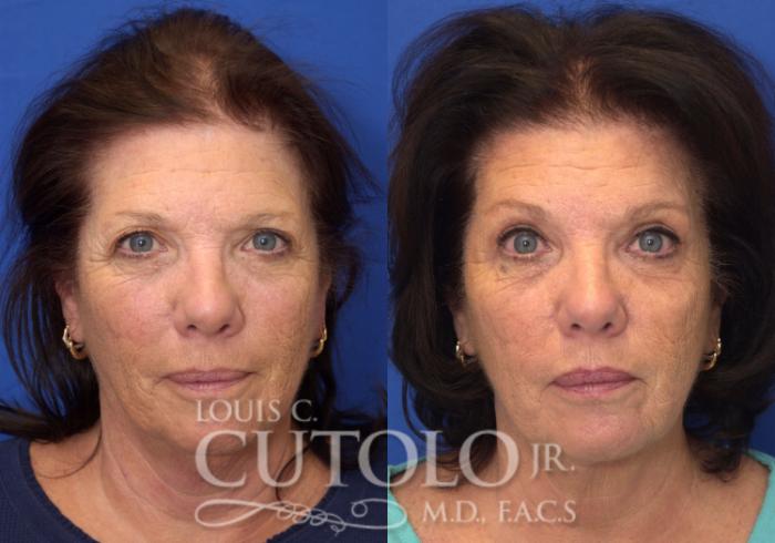 Before & After Eyelid Surgery Case 53 View #1 View in Brooklyn, Staten Island, Queens, NY