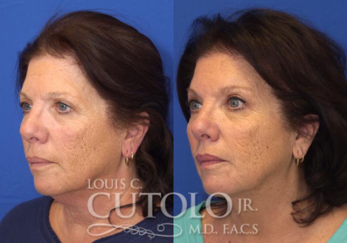 Before & After Eyelid Surgery Case 53 View #2 View in Brooklyn, Staten Island, Queens, NY