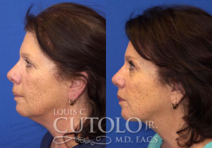 Before & After Eyelid Surgery Case 53 View #3 View in Brooklyn, Staten Island, Queens, NY