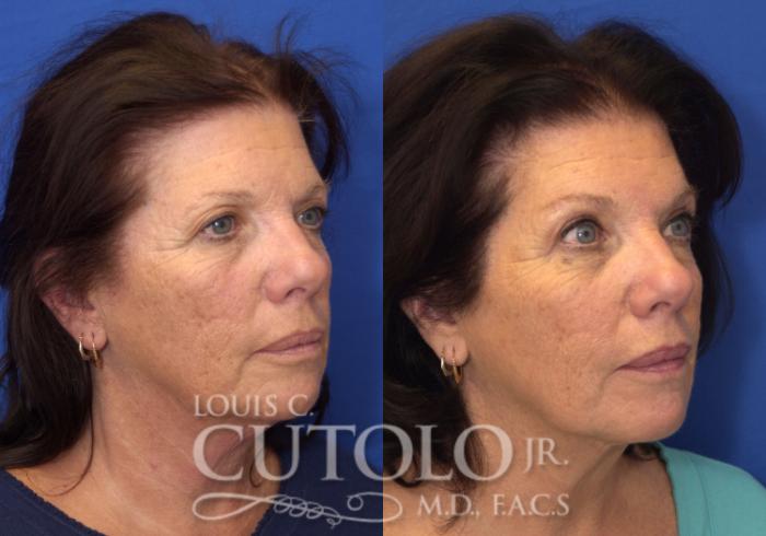 Before & After Eyelid Surgery Case 53 View #4 View in Brooklyn, Staten Island, Queens, NY
