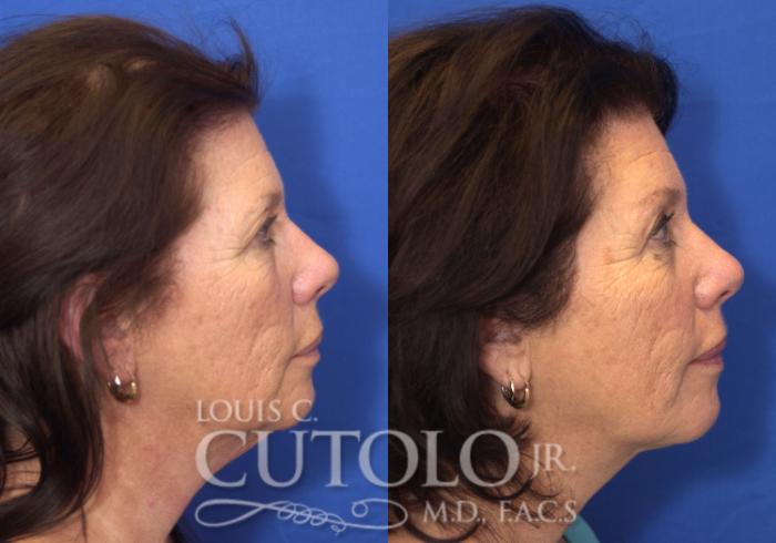 Before & After Eyelid Surgery Case 53 View #5 View in Brooklyn, Staten Island, Queens, NY