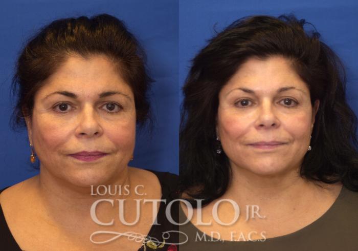 Before & After FaceTite Case 213 View #1 View in Brooklyn, Staten Island, Queens, NY