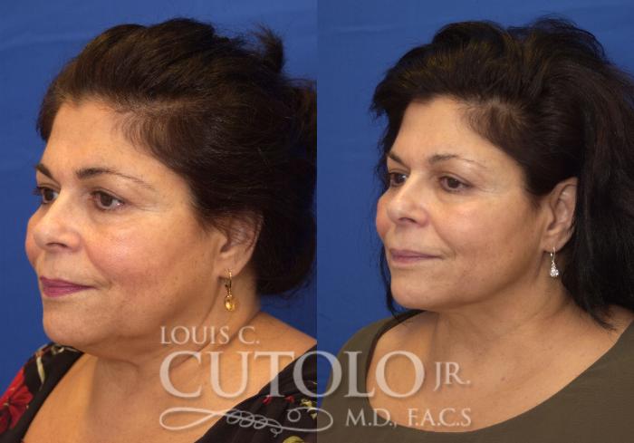 Before & After FaceTite Case 213 View #2 View in Brooklyn, Staten Island, Queens, NY