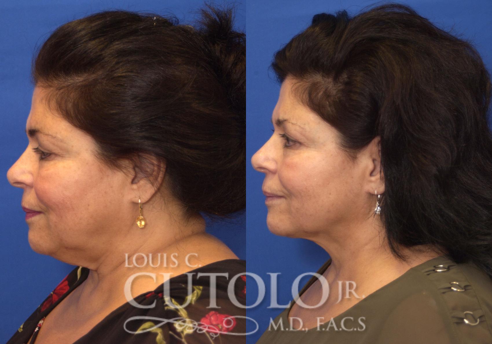 Before & After FaceTite Case 213 View #3 View in Brooklyn, Staten Island, Queens, NY