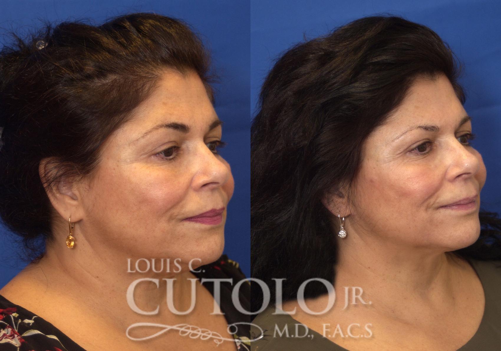 Before & After FaceTite Case 213 View #4 View in Brooklyn, Staten Island, Queens, NY