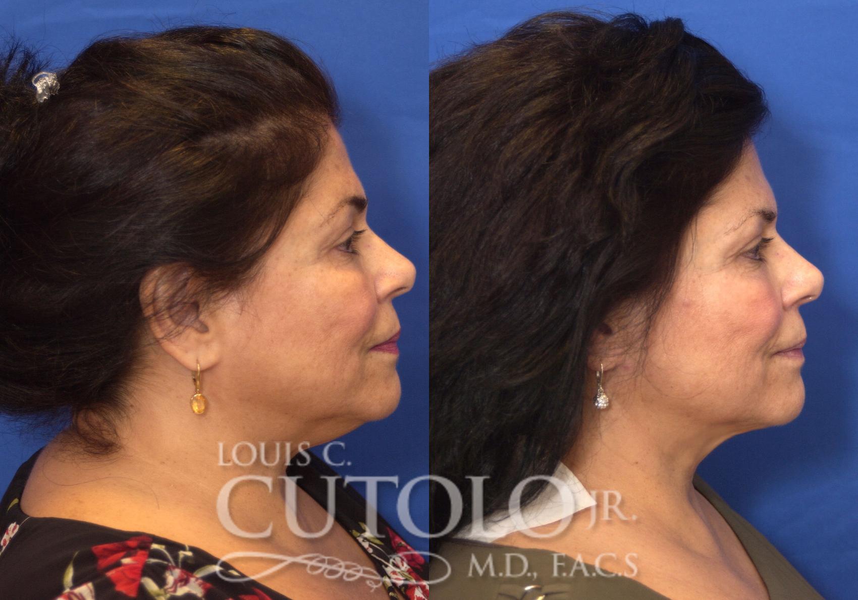 Before & After FaceTite Case 213 View #5 View in Brooklyn, Staten Island, Queens, NY