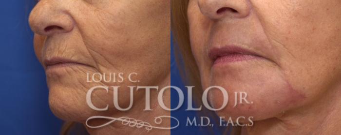 Before & After Laser Skin Resurfacing Case 150 View #2 View in Brooklyn, Staten Island, Queens, NY