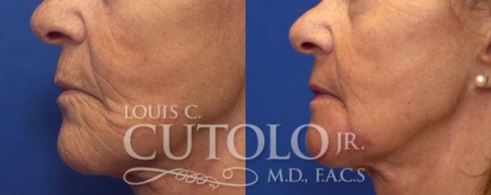 Before & After Laser Skin Resurfacing Case 150 View #3 View in Brooklyn, Staten Island, Queens, NY