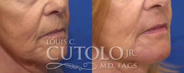 Before & After Laser Skin Resurfacing Case 150 View #4 View in Brooklyn, Staten Island, Queens, NY