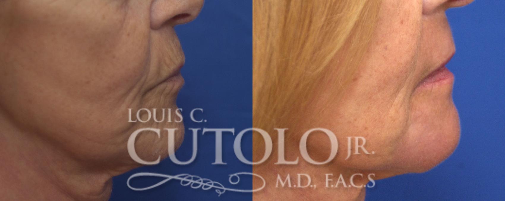 Before & After Laser Skin Resurfacing Case 150 View #5 View in Brooklyn, Staten Island, Queens, NY
