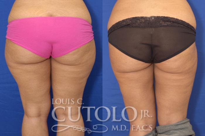 Before & After Liposuction Case 12 View #2 View in Brooklyn, Staten Island, Queens, NY