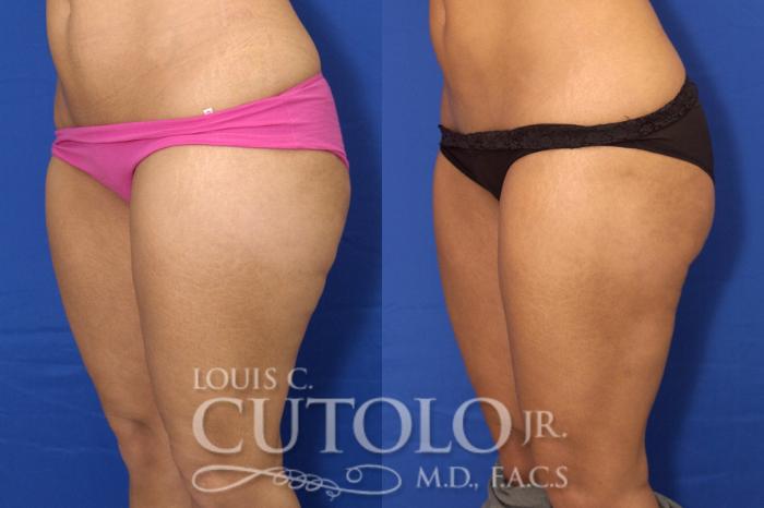 Before & After Liposuction Case 12 View #3 View in Brooklyn, Staten Island, Queens, NY