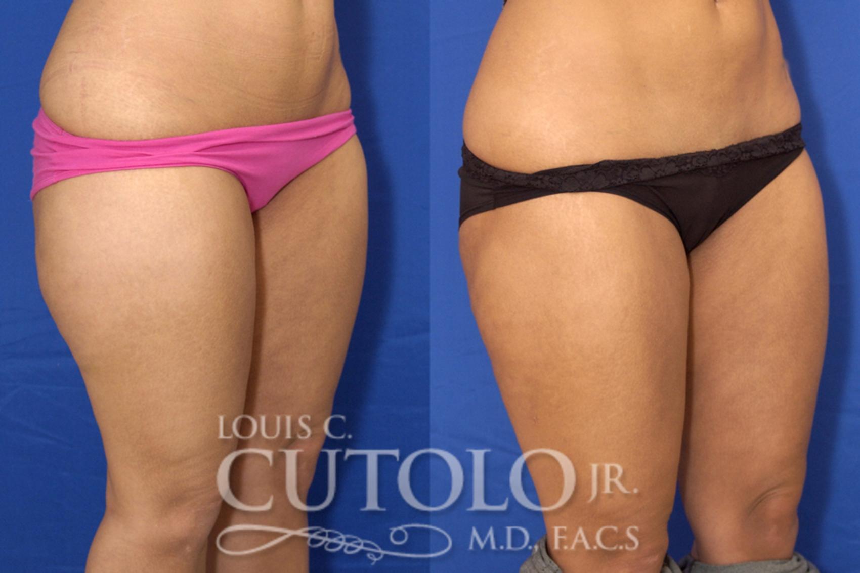 Before & After Liposuction Case 12 View #4 View in Brooklyn, Staten Island, Queens, NY