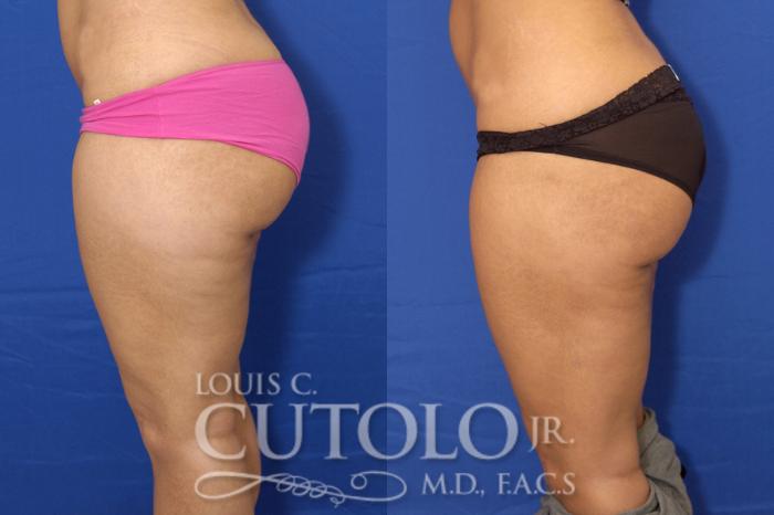 Before & After Liposuction Case 12 View #5 View in Brooklyn, Staten Island, Queens, NY