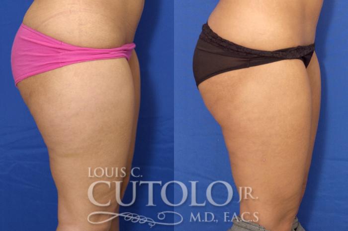 Before & After Liposuction Case 12 View #6 View in Brooklyn, Staten Island, Queens, NY