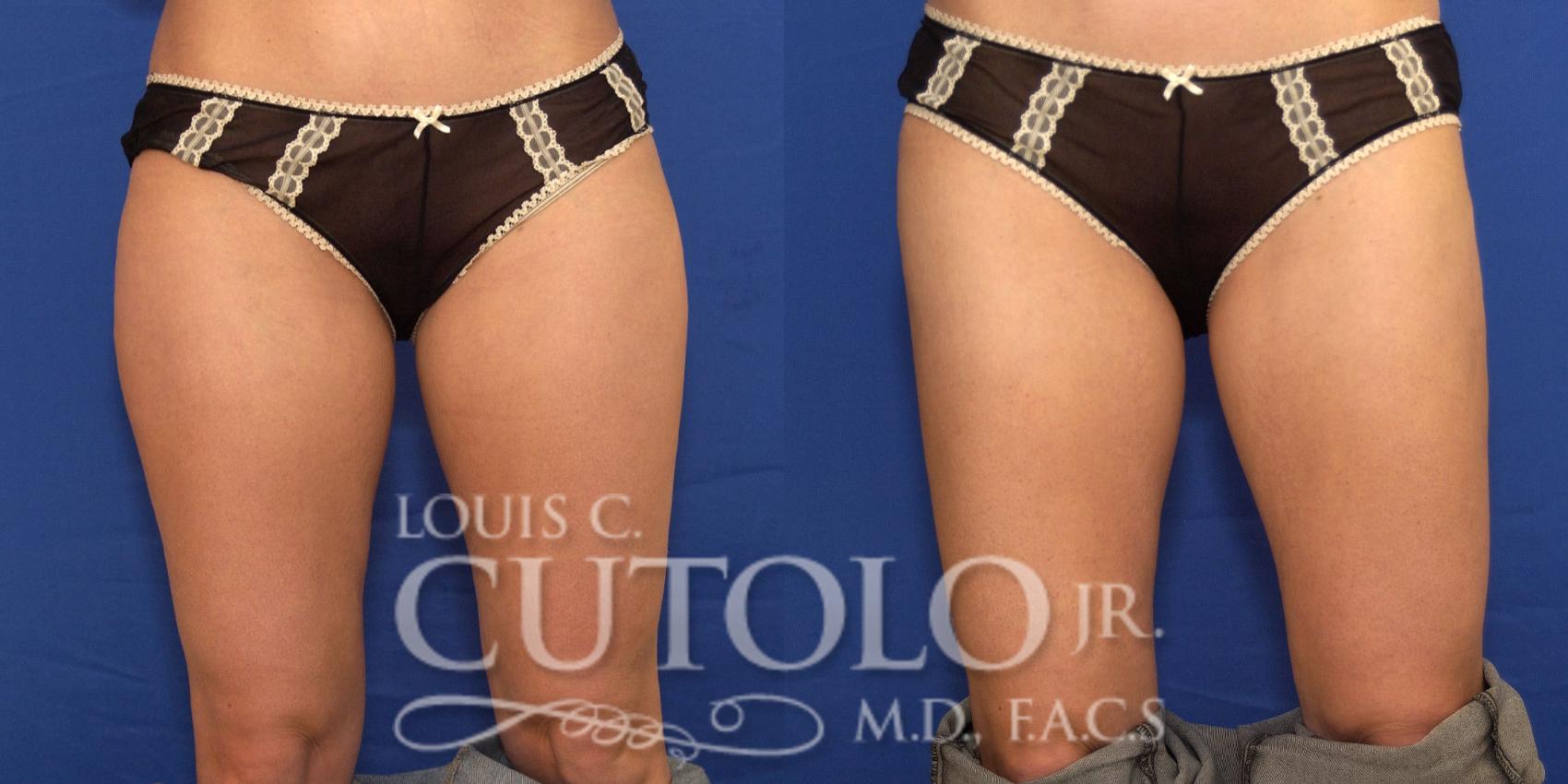 Before & After Liposuction Case 181 View #1 View in Brooklyn, Staten Island, Queens, NY