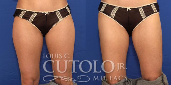Before & After Liposuction Case 181 View #1 View in Brooklyn, Staten Island, Queens, NY