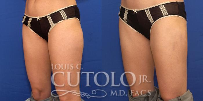 Before & After Liposuction Case 181 View #2 View in Brooklyn, Staten Island, Queens, NY