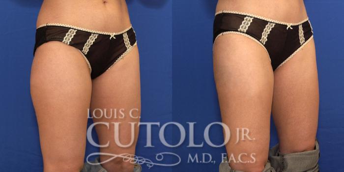 Before & After Liposuction Case 181 View #3 View in Brooklyn, Staten Island, Queens, NY