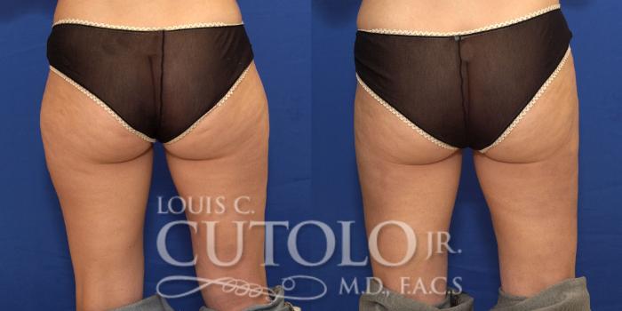 Before & After Liposuction Case 181 View #4 View in Brooklyn, Staten Island, Queens, NY