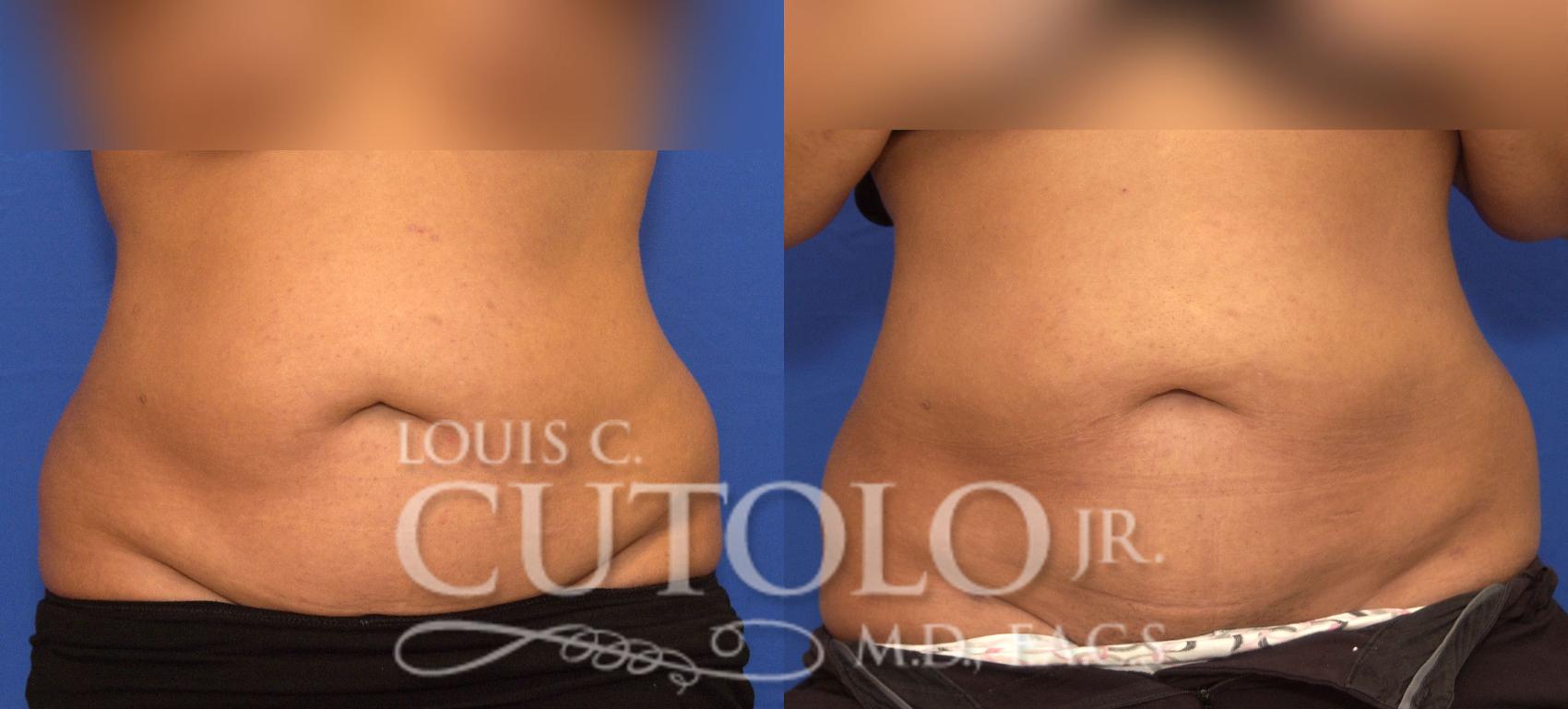 Before & After Liposuction Case 57 View #1 View in Brooklyn, Staten Island, Queens, NY