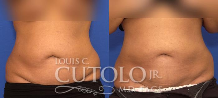 Before & After Liposuction Case 57 View #1 View in Brooklyn, Staten Island, Queens, NY