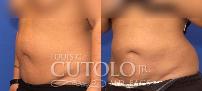 Before & After Liposuction Case 57 View #2 View in Brooklyn, Staten Island, Queens, NY