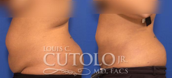 Before & After Liposuction Case 57 View #3 View in Brooklyn, Staten Island, Queens, NY