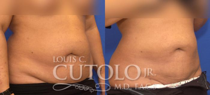 Before & After Liposuction Case 57 View #4 View in Brooklyn, Staten Island, Queens, NY