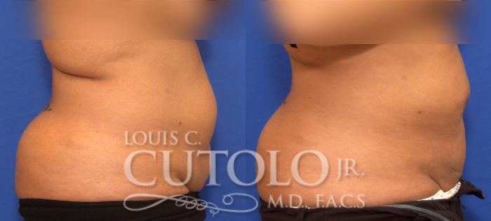 Before & After Liposuction Case 57 View #5 View in Brooklyn, Staten Island, Queens, NY