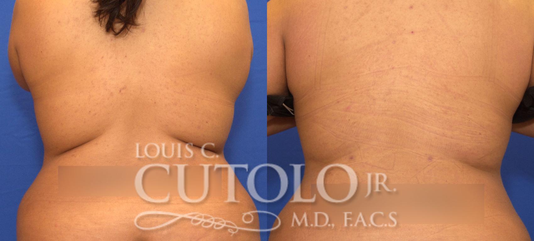 What Areas Can Liposuction Treat? (Infographic) – Louis C. Cutolo, Jr.,  M.D., F.A.C.S.