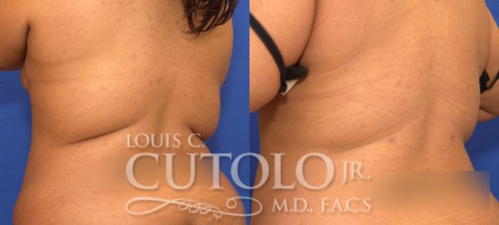 Before & After Liposuction Case 57 View #7 View in Brooklyn, Staten Island, Queens, NY