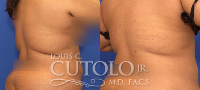 Liposuction Before and After Pictures Case 57, Brooklyn, Staten Island,  Queens, NY