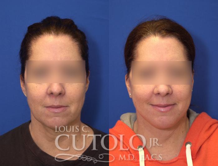 Before & After Rejuvelift™ Case 105 View #1 View in Brooklyn, Staten Island, Queens, NY