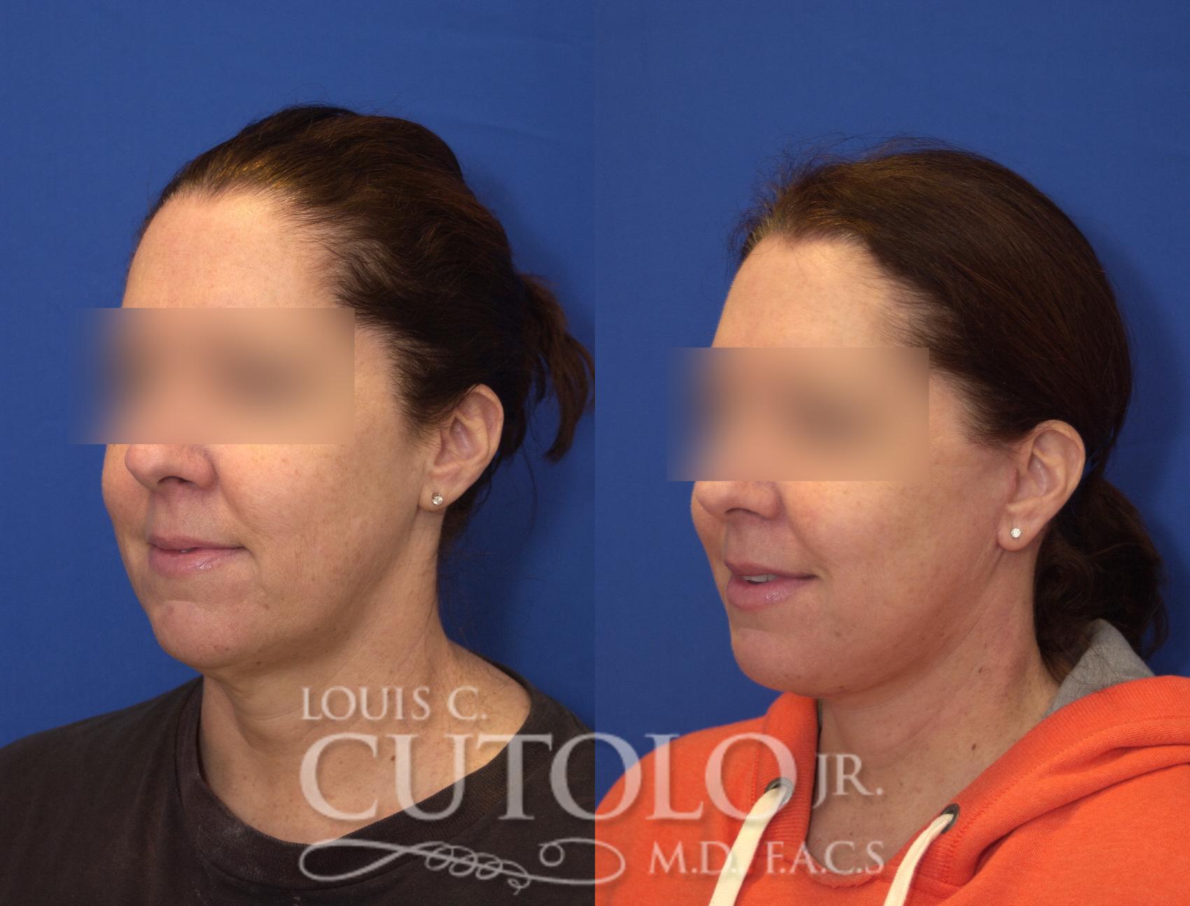 Before & After Rejuvelift™ - Mini Lift Case 105 View #2 View in Brooklyn, Staten Island, Queens, NY