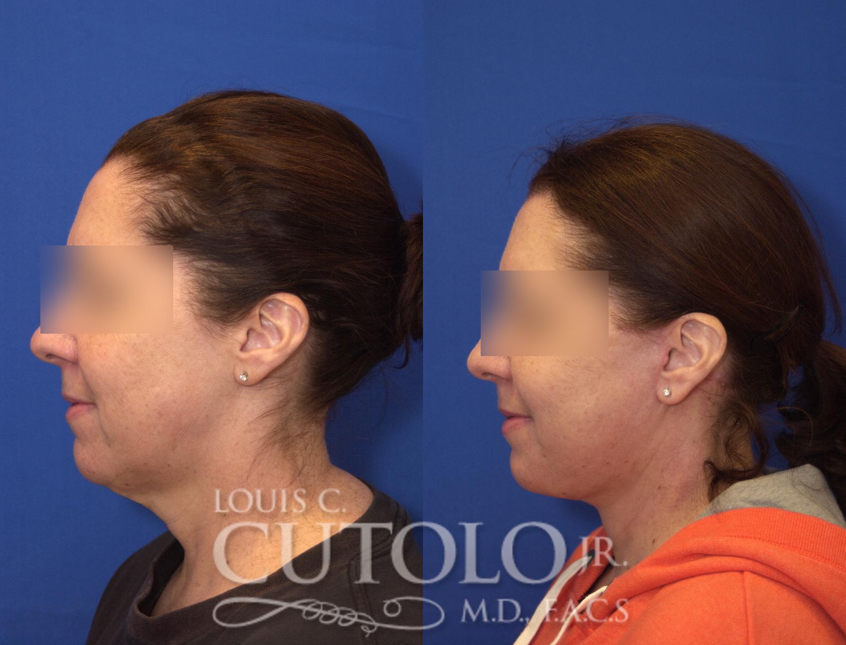 Before & After Rejuvelift™ - Mini Lift Case 105 View #3 View in Brooklyn, Staten Island, Queens, NY
