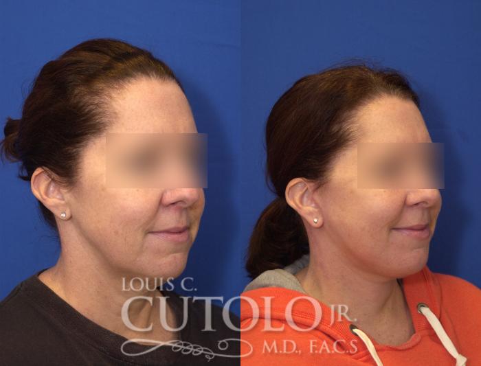 Before & After Rejuvelift™ Case 105 View #4 View in Brooklyn, Staten Island, Queens, NY