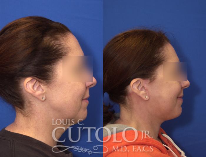 Before & After Rejuvelift™ Case 105 View #5 View in Brooklyn, Staten Island, Queens, NY