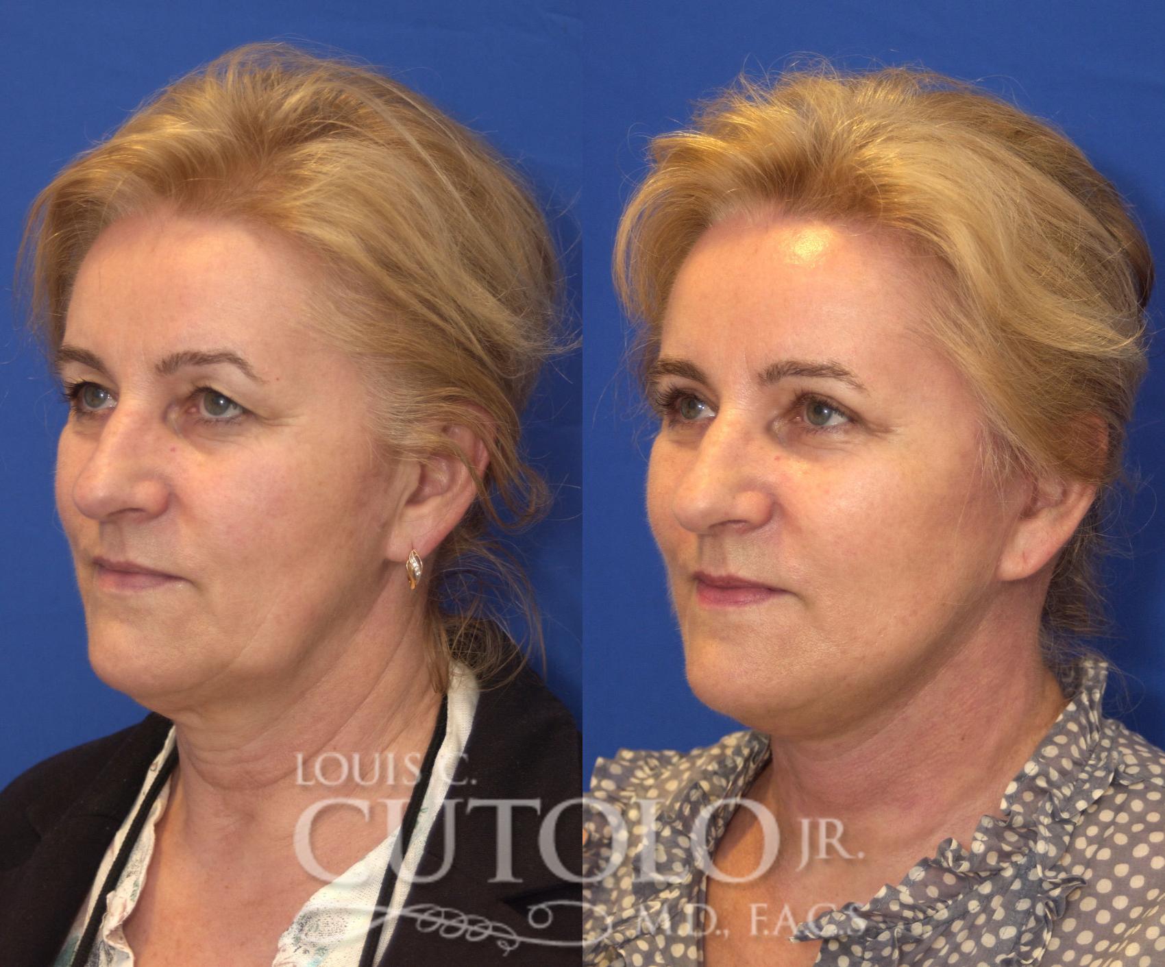 Before & After Rejuvelift™ - Mini Lift Case 118 View #2 View in Brooklyn, Staten Island, Queens, NY