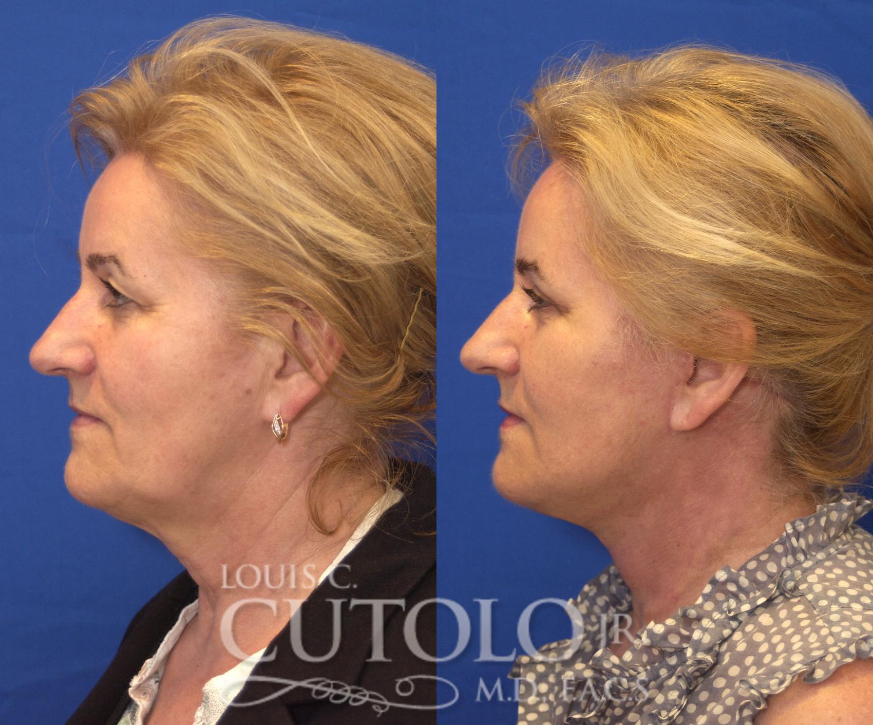 Before & After Rejuvelift™ - Mini Lift Case 118 View #3 View in Brooklyn, Staten Island, Queens, NY