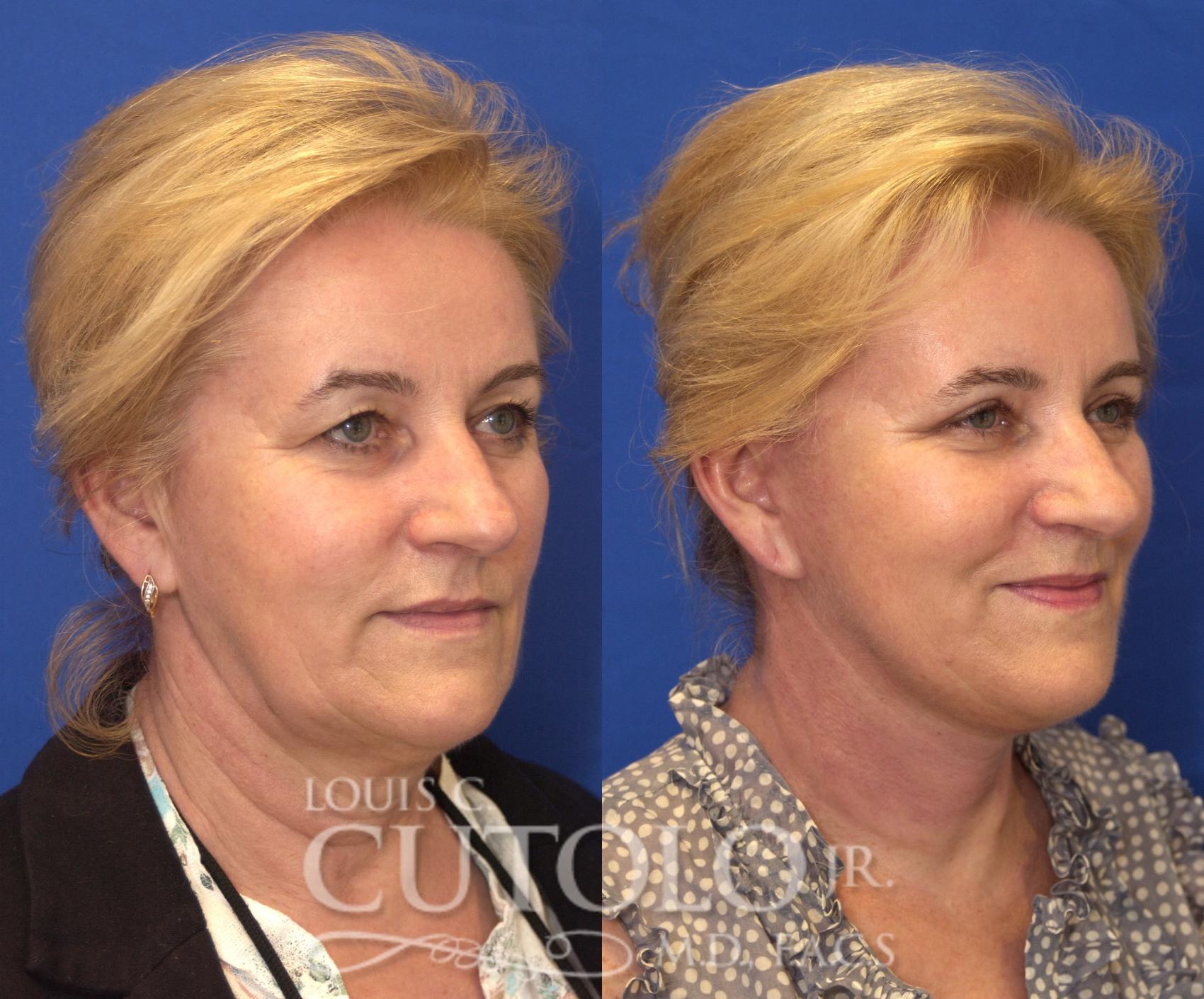 Before & After Rejuvelift™ - Mini Lift Case 118 View #4 View in Brooklyn, Staten Island, Queens, NY
