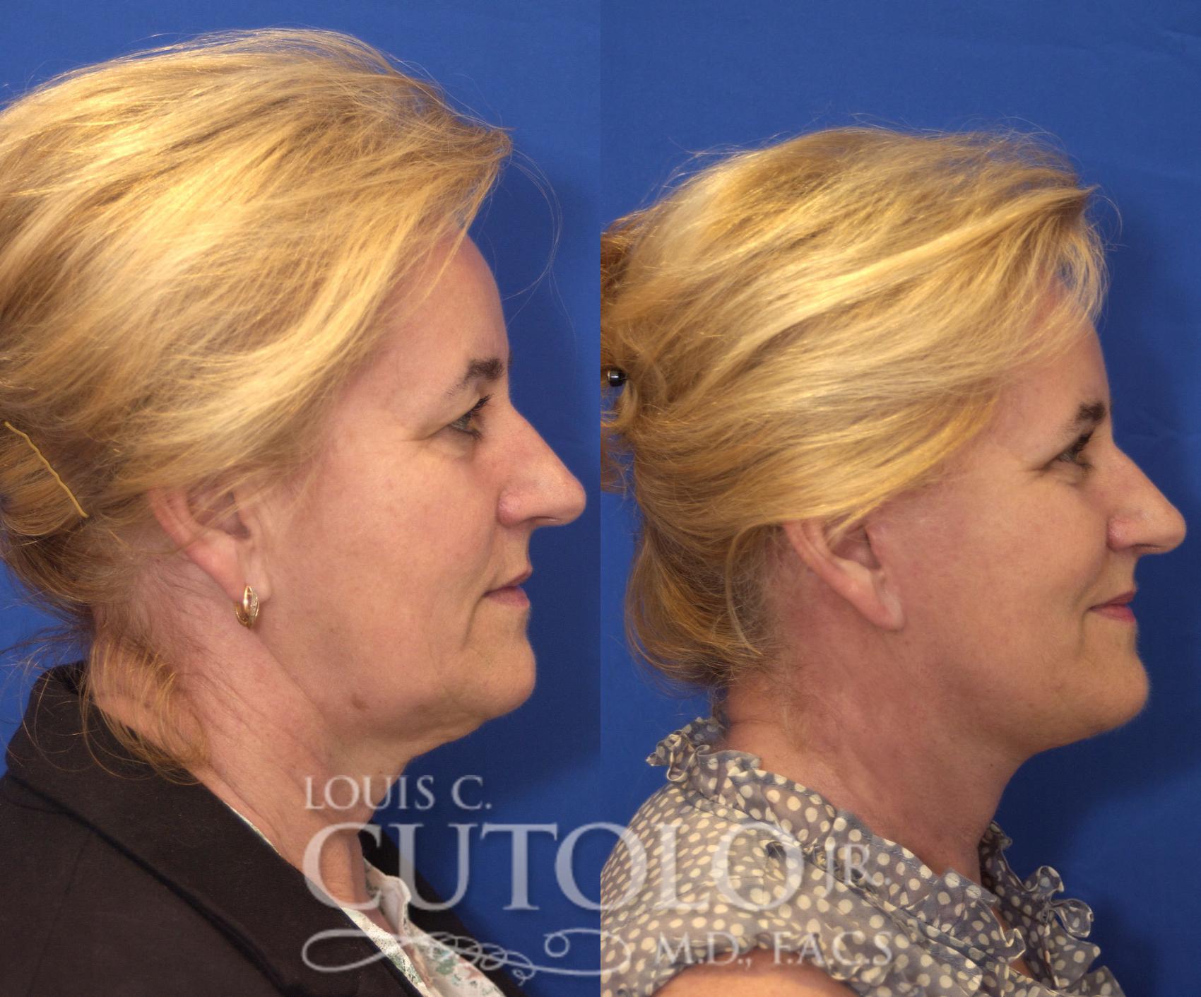 Before & After Rejuvelift™ - Mini Lift Case 118 View #5 View in Brooklyn, Staten Island, Queens, NY